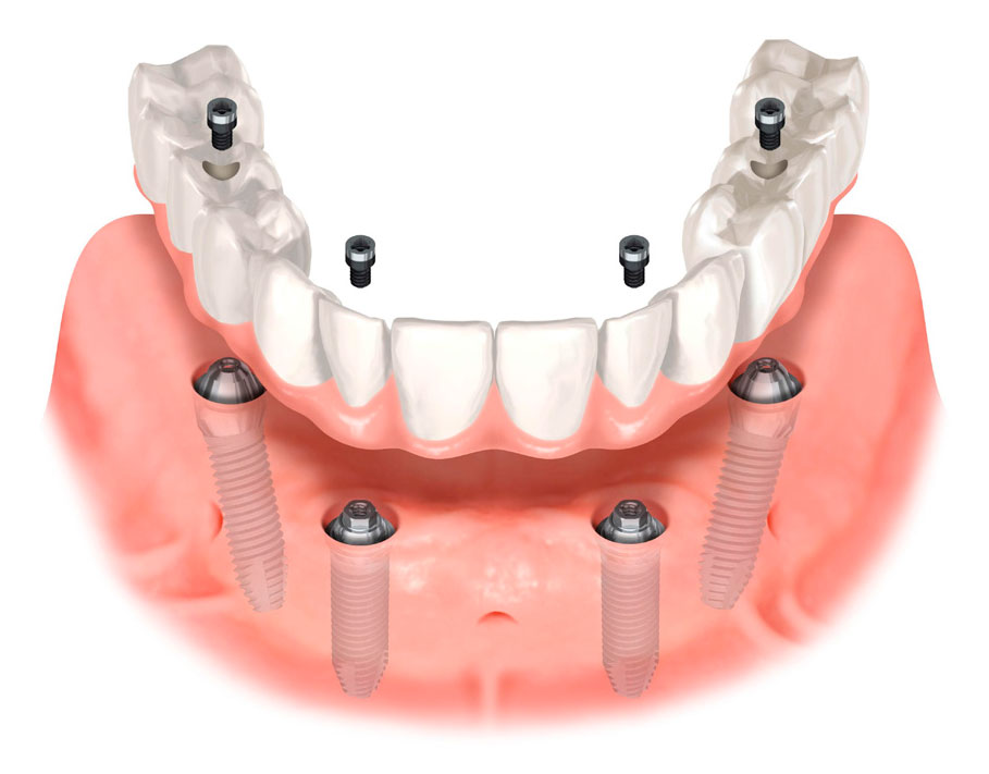 Dental Implants To Replace Missing Teeth - Moorestown, NJ & Medford, NJ
