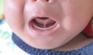 Baby with open mouth, showing tongue-tie and frena before a frenectomy