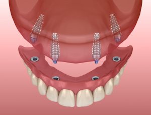 the dental implant process