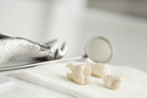Tooth Extraction: Steps For Healing Properly