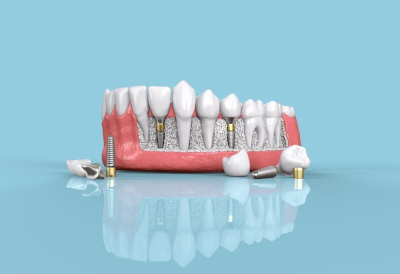 Dental Implant components