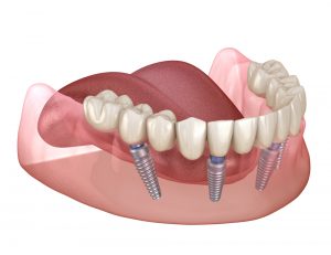 Regain Your Smile With All-On-4 Implants