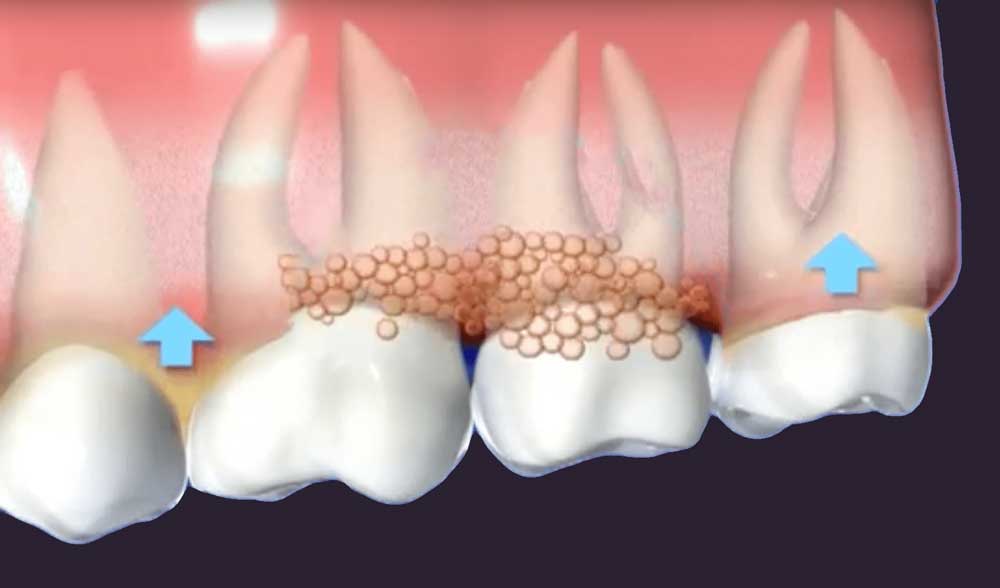 diagram depicting infected gums